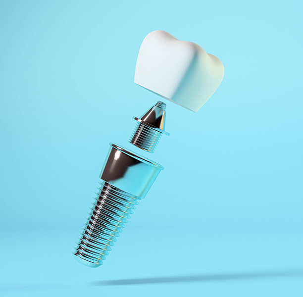 Illustration of a dental implant