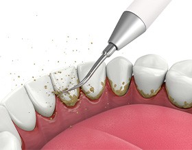 Back view of teeth during scaling and root planing