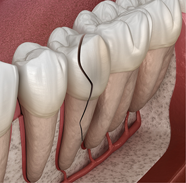Illustration of a cracked tooth