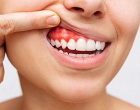 A cropped shot of a young woman revealing her inflamed gums