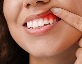 A woman showing her red and irritated gums