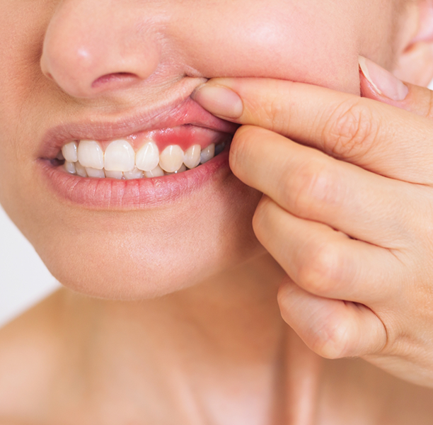 Person pointing to a red spot in their gums