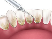 Illustration of teeth receiving scaling and root planing